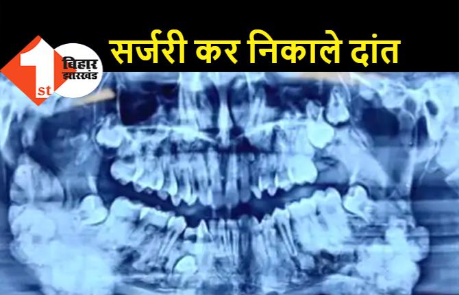 नीतीश के मुंह में 82 दांत, पटना के डॉक्टरों ने सर्जरी कर निकाला