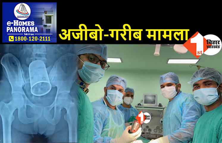 मलद्वार से निकाला गया स्टील का ग्लास, PMCH में युवक का हुआ सफल ऑपरेशन