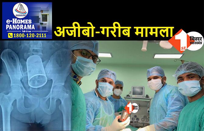 मलद्वार से निकाला गया स्टील का ग्लास, PMCH में युवक का हुआ सफल ऑपरेशन