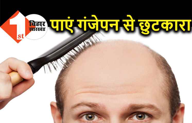 गंजेपन से पाना चाहते हैं छुटकारा, तो अपनी दिनचर्या में शामिल करें ये उपाय